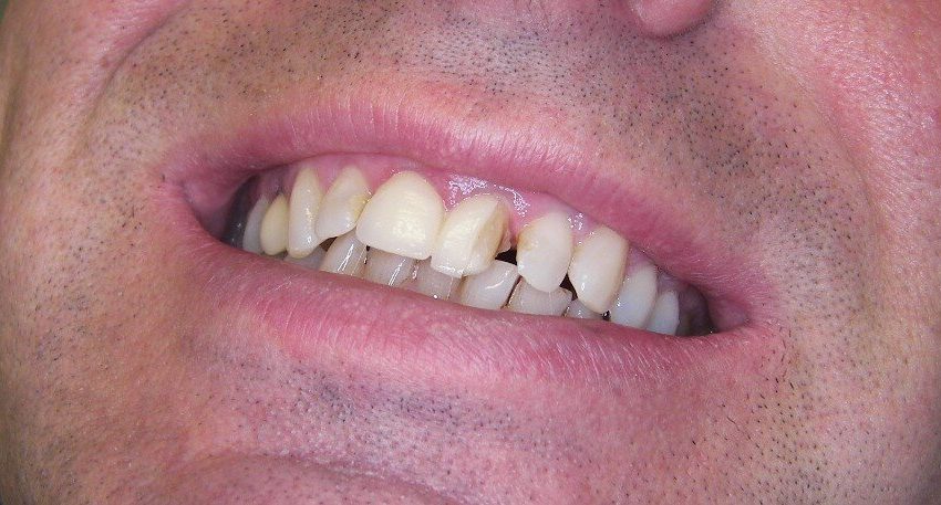  How Can I Prevent My Veneer From Breaking? 