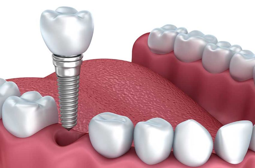 How Tooth Replacement in NYC Can Help Prevent Bone Loss